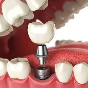 Implantes Neodent em Setor Sul - GO